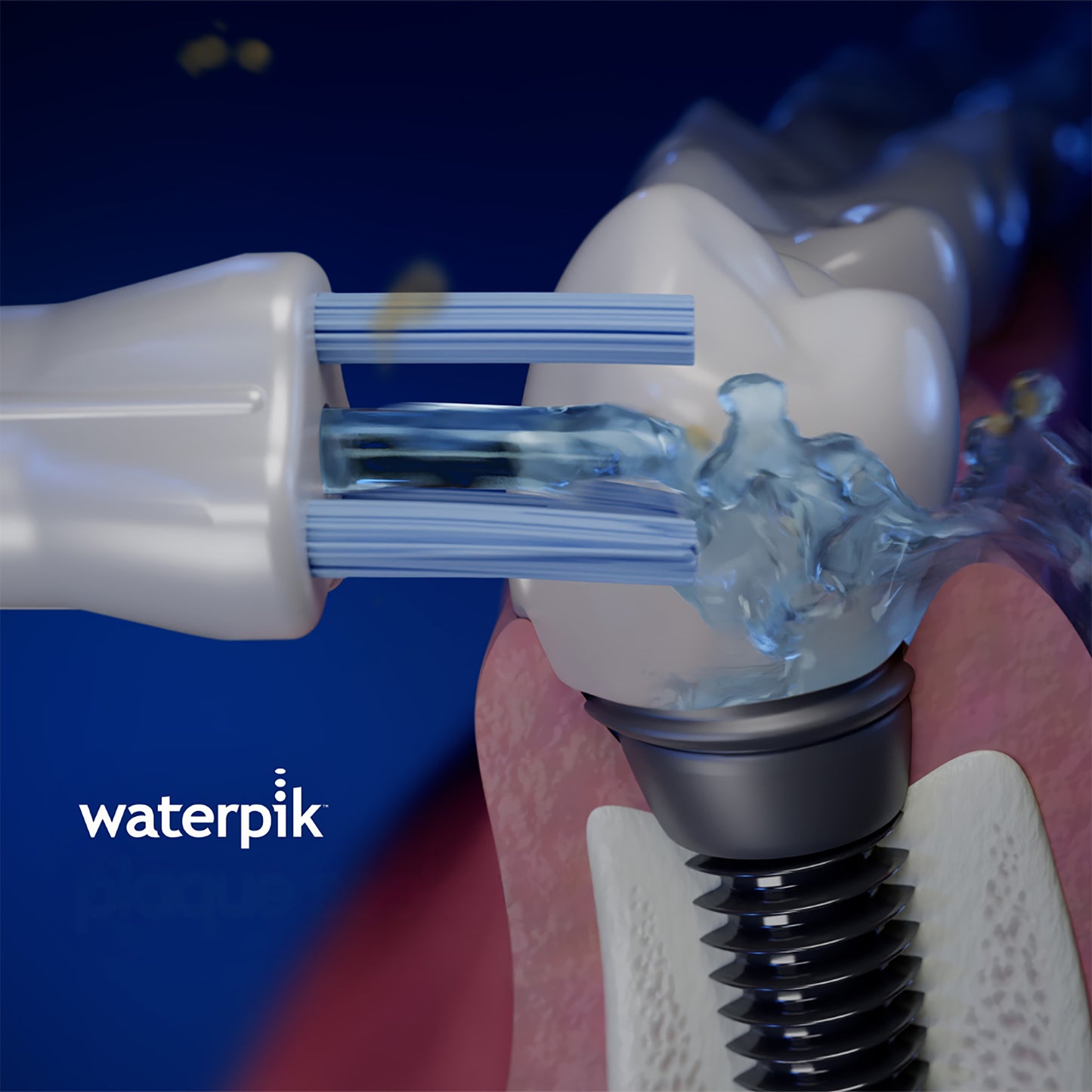 Using the Waterpik™ Plaque Seeker™ Tip