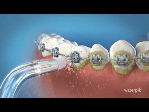 Learn how to use the Waterpik™ Orthodontic Tip.