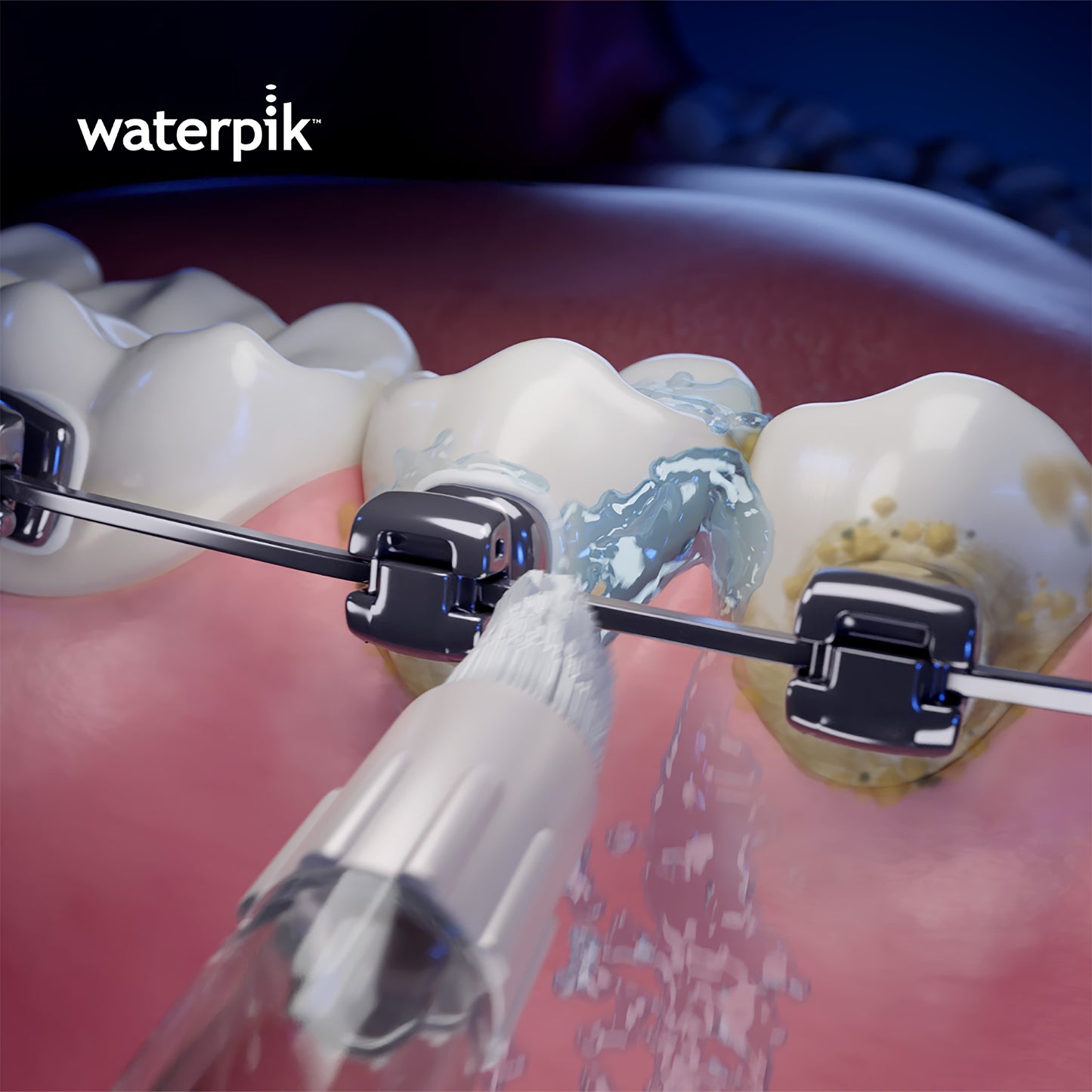 Using Waterpik™ Orthodontic Tip