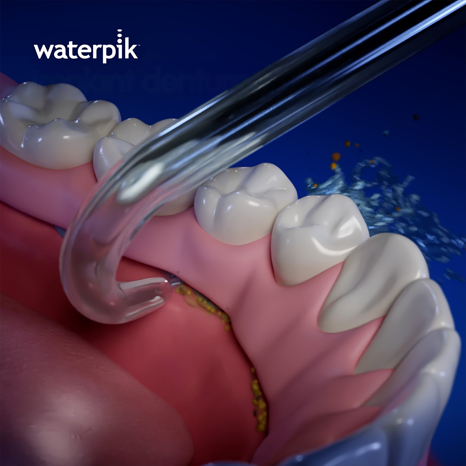 Using the Waterpik™ Implant Denture Tip DT-100E on Lower Arch 